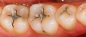 Amalgam-Fillings