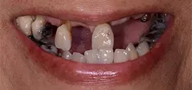 teeth-in-a-day-before