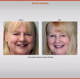 2018-implants-case-6