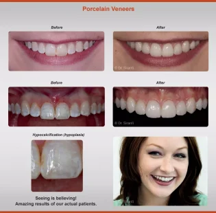 2018-veneers-case-1