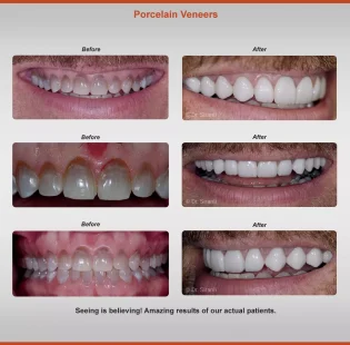 2018-veneers-case-2