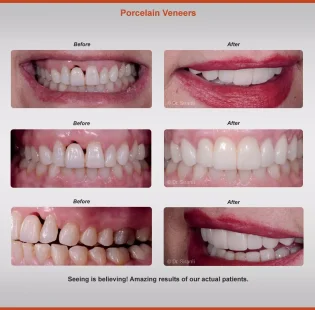 2018-veneers-case-3