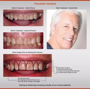 2018-veneers-case-4