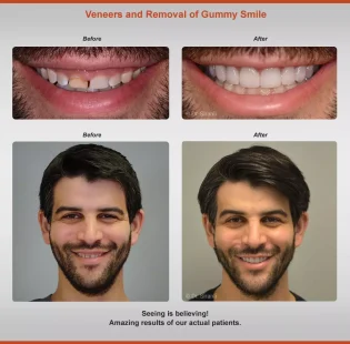 Dental Veneers