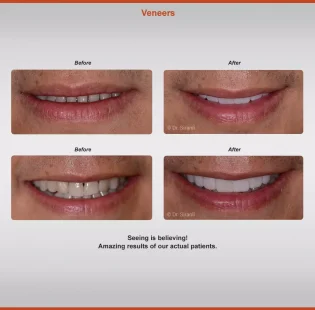 2020-veneers-2