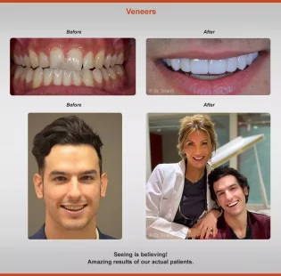 2020-veneers-3